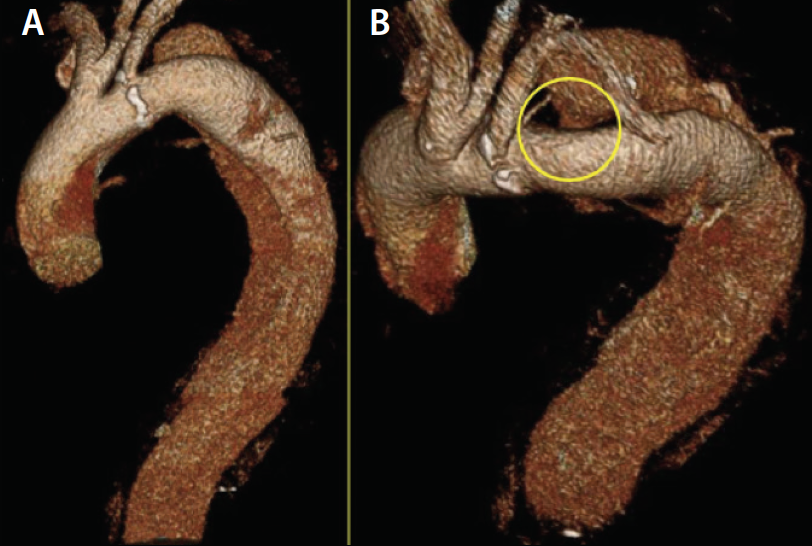 Thoracic Aortic Aneurysm 3d