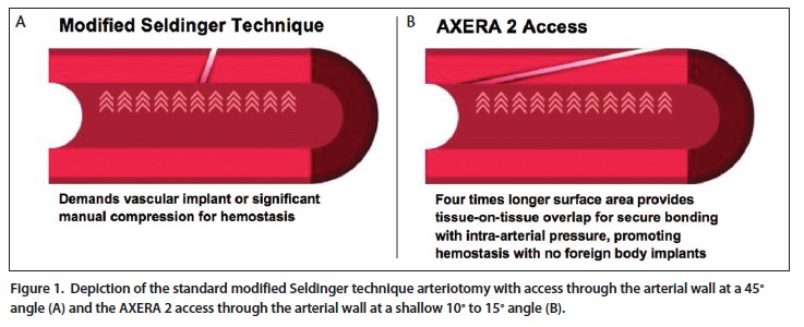 Seldinger Vs Modified – Original Seldinger Method – ZDWXBQ