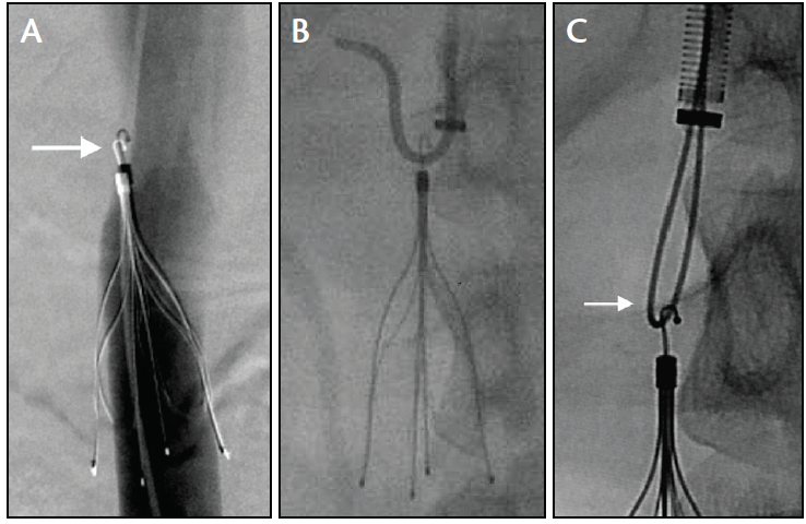 Endovascular Today Current IVC Filter Retrieval Techniques July 2017 Endovascular Today Current IVC Filter Retrieval Techniques July 2017
